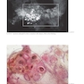 دانلود کتاب Breast Cancer: Early Detection with Mammography: Crushed Stone-like  ... 