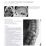 دانلود کتاب Neurosurgery Case Review: Questions and Answers 2nd Edition 2020