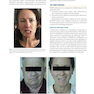 دانلود کتاب Management of Post-Facial Paralysis Synkinesis