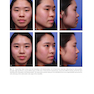 دانلود کتاب Aesthetic Plastic Surgery of the East Asian Face