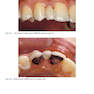 دانلود کتاب Rbfdps : Resin-Bonded Fixed Dental Prostheses: Minimally Invasive -  ... 
