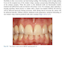 دانلود کتاب Rbfdps : Resin-Bonded Fixed Dental Prostheses: Minimally Invasive -  ... 
