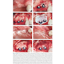 دانلود کتاب 30Years of Guided Bone Regeneration in Implant Dentistry