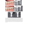 دانلود کتاب 30Years of Guided Bone Regeneration in Implant Dentistry