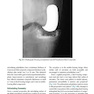 دانلود کتاب Unicompartmental Knee Arthroplasty