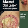 دانلود کتاب Advanced Skin Cancer: A Case-Based Approach