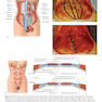 دانلود کتاب Atlas of Abdominoplasty